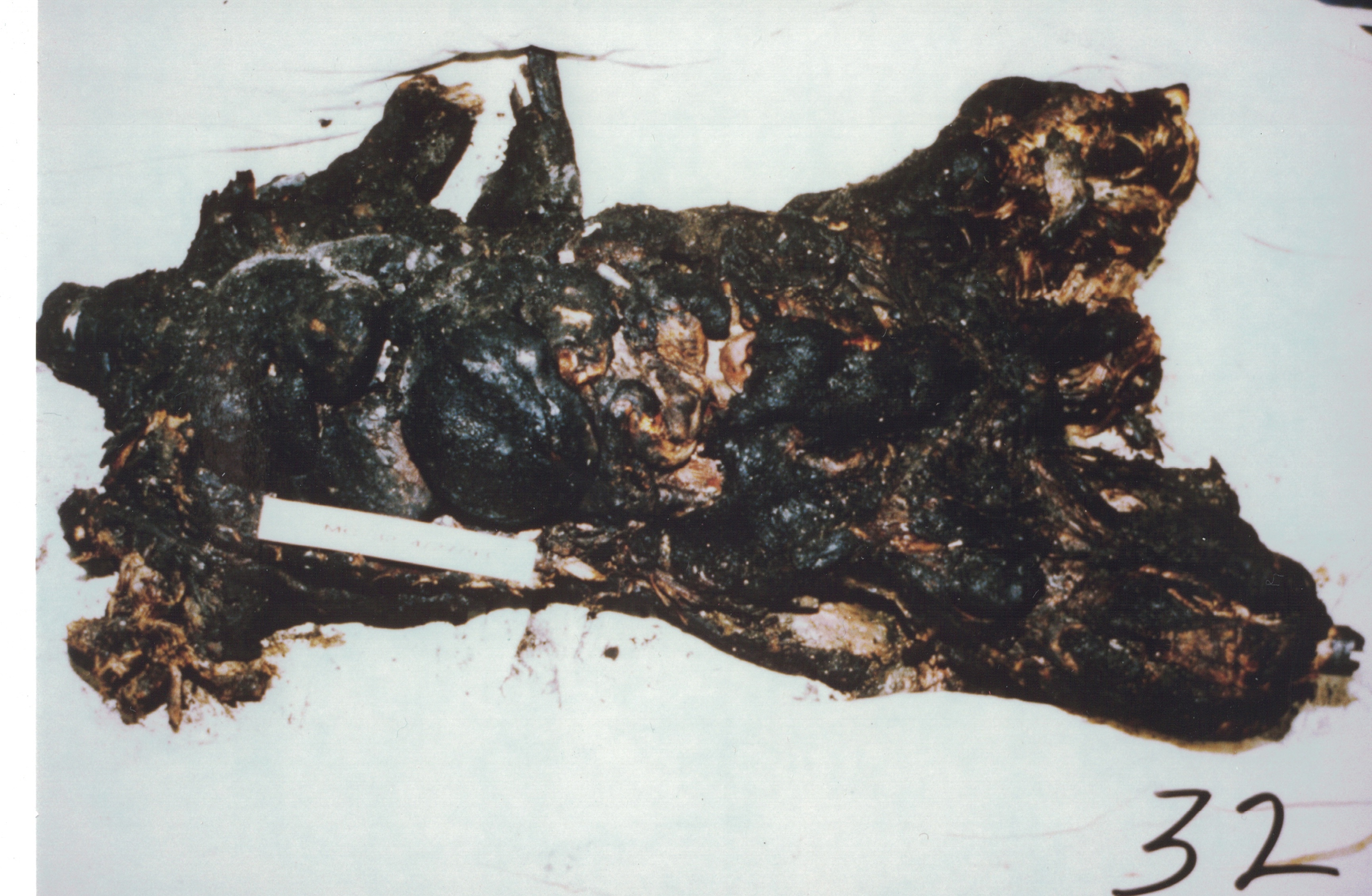 Autopsy picture of John McBean